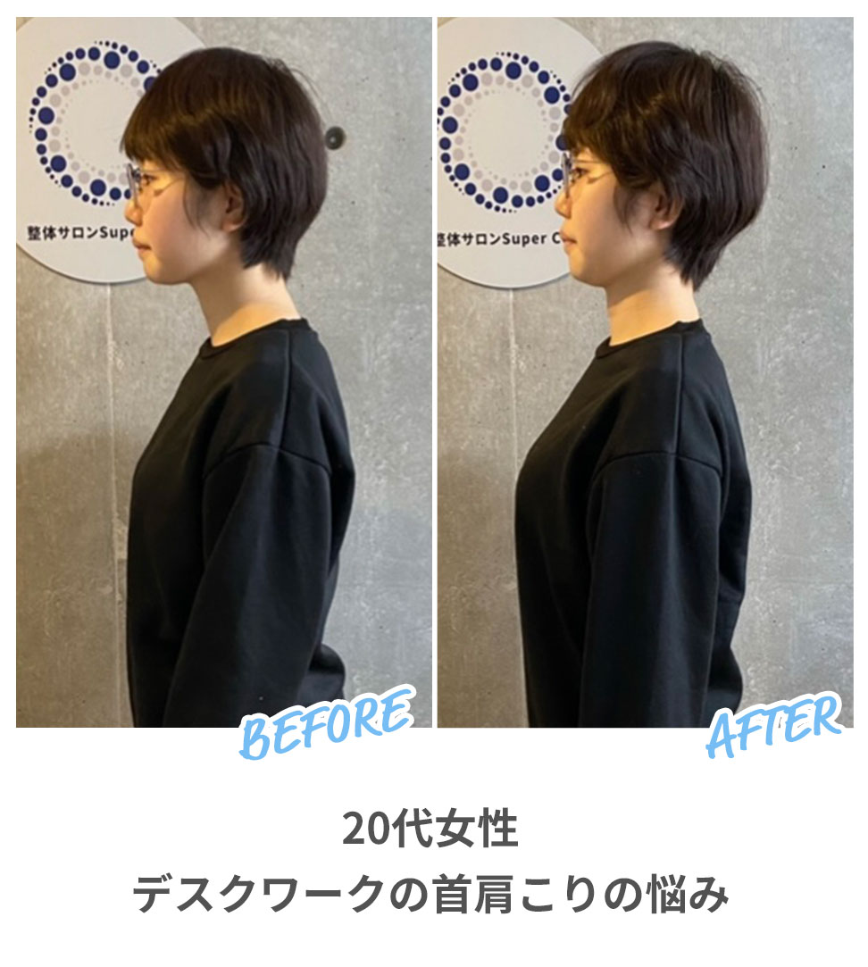 BEFORE/AFTER：20代女性デスクワークの首肩こりの悩み