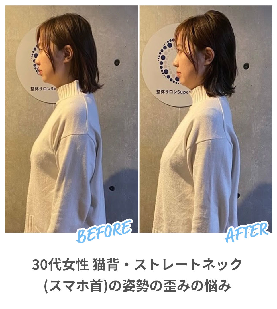 BEFORE/AFTER：30代女性 猫背・ストレートネック（スマホ首）の姿勢の歪みの悩み